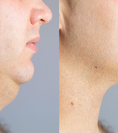 double chin removal