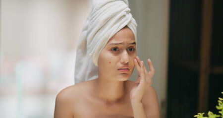 Natural skincare for acne